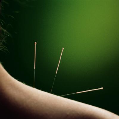 Acupuncture epaule